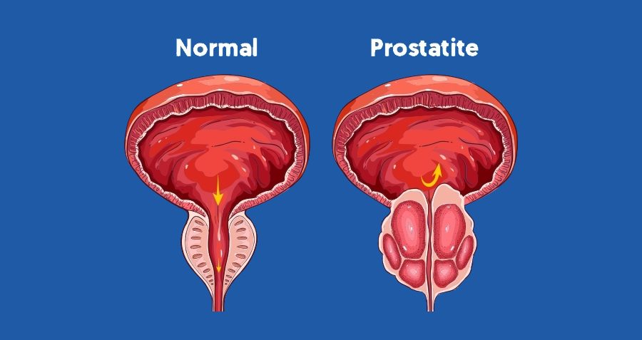 prostatite sintomi