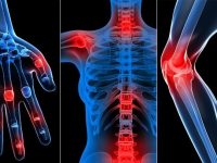 osteoartrite artrite