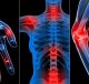 osteoartrite artrite