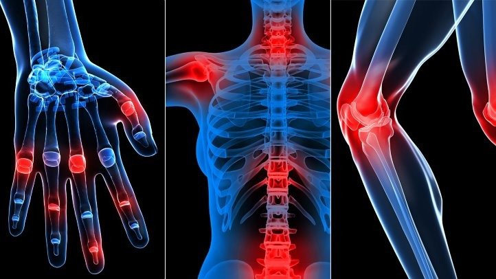 osteoartrite artrite